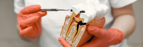 Effect of Q Mix and Without a Canal Brush on Smear Layer and Debris Removal after Instrumentation with Protaper Next and Wave one an SEM Study