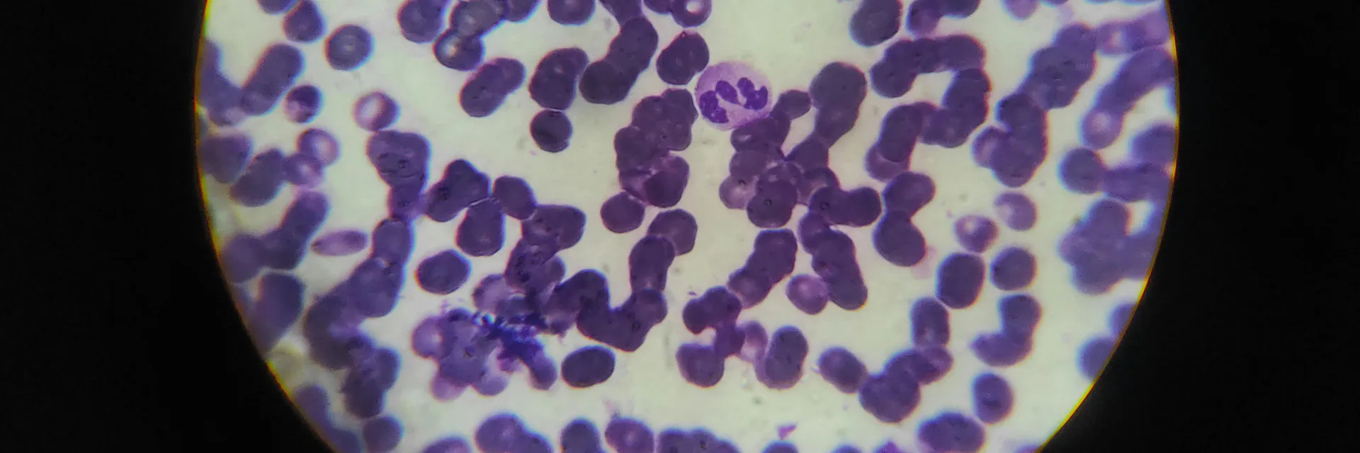 Testicular Filariasis – A Case Report Banner