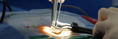 Cirurgia de Whipple no Trauma: Relato de Caso de Lesão Complexa Por Arma de Fogo
