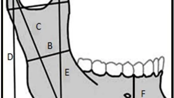Gender Determination by Measuring The Mandibular Ramus and Body of The Mandible: A Retrospective Radiographic Study