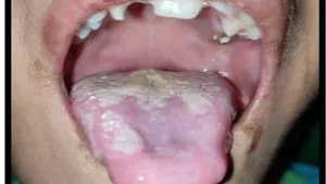 The Silent Sufferers: Congenital Insensitivity to Pain with Anhidrosis  (CIPA): A Case Report