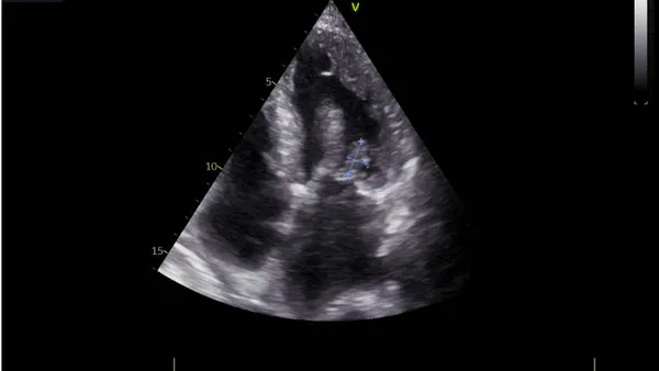 Urothelial Carcinoma Associated with Infective Endocarditis Due to a Leuconostoc Species: A Rare Presentation