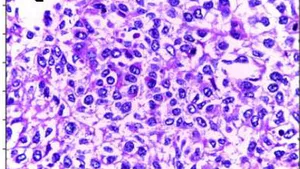 Histological Grading of Breast Cancer Malignancy Using Automated Image Analysis and Subsequent Machine Learning