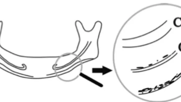 Correlation between Radiomorphometric Indexes and Low Bone Quality in the Success of Osseointegration in Oral Rehabilitation