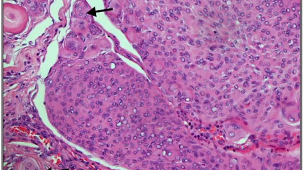 Inter-Observer Variation in the Grading of Meningiomas using the WHO Classification of CNS Tumors Criteria