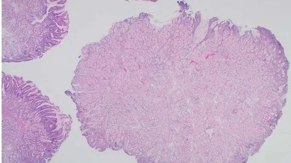 Brunner Gland Adenoma with a KRAS G12D Point Mutation
