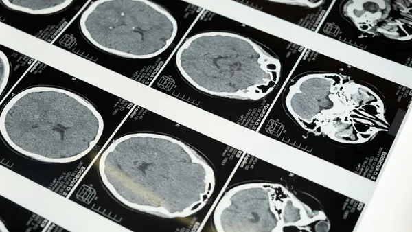 Evoked Potentials in the Prognosis of Surgical Treatment of Cerebellar Syndrome in Chiari Malformation Type 1