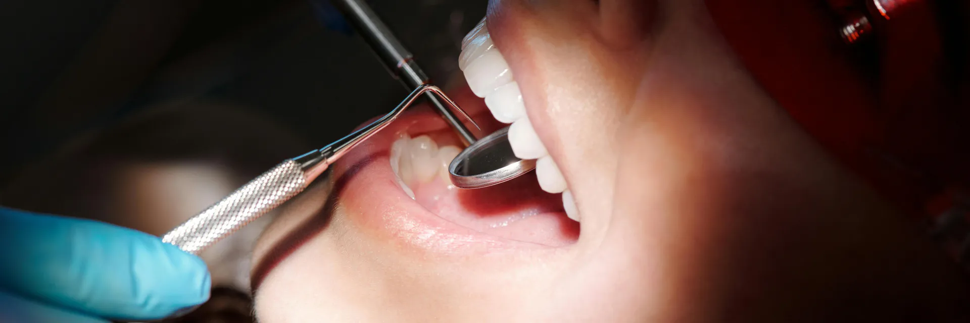 Tooth Loss among Cancer Patients: Prevalence and Factors Associated with the Position and Number of Missing Teeth Banner