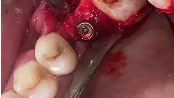 Lateral Approach Sinus (LAS) and Crestal Approach Sinus (CAS): The Unravelled Paraphernalia for Maxillary Sinus Membrane Advancement