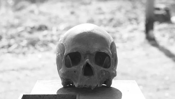 Craniofacial Features of Cleidocranial Dysplasia(CCD) – A Case Report
