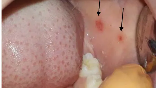 Oral Lesions in Pediatric Patients in North Mexico with Acute Lymphoblastic Leukemia or Type 1 Diabetes Mellitus as Underlying Disease