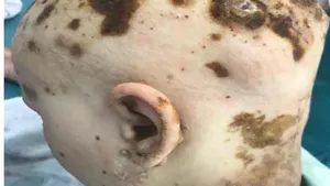 KID Syndrome Complicated by Multiple Abscesses of the Parietal Region Skin: Clinical Case