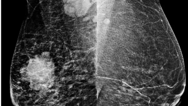 Axillary Nodal Metastases – Prediction by Ultrasound and Digital Mammogram Features of Primary Breast Malignancy