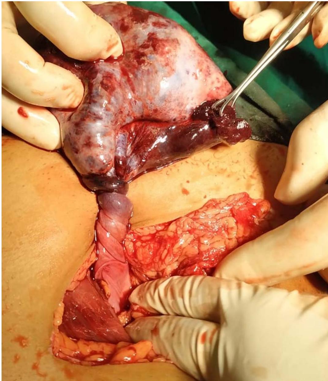A Study of Giant Ovarian Tumors Presenting with Higher Incidence of Torsion: A Journey of my Experience in COVID-19 Pandemic at Tertiary Care Centre