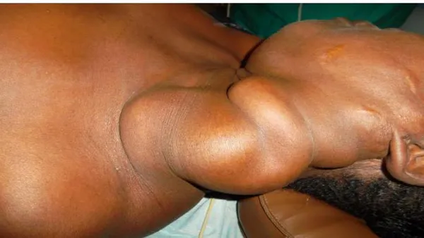 Epidemiological, Clinical, and Therapeutic Aspects of Tumors and Vascular Malformations in Senegal: About 52 Cases