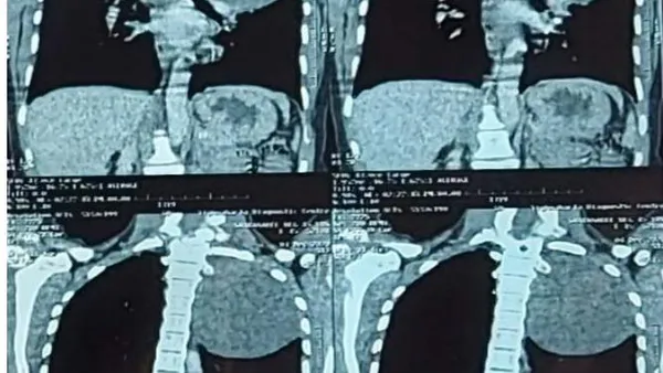 Thoracic Ganglioneuroma : A Case Report