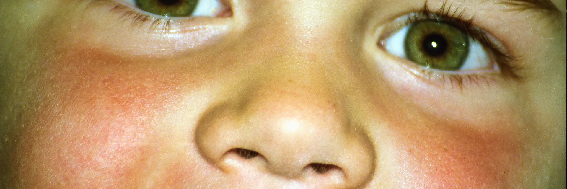 Literature Review: Oral Rehabilitation in Patients Up to 16 years old with Hypohidrotic Ectodermal Dysplasia (HED) Banner