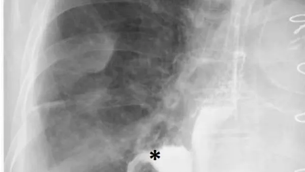 Esophageal-Pleural Fistula after Intraoperative Transoesophageal Echocardiography in A Patient with Enlarged Left Atrium
