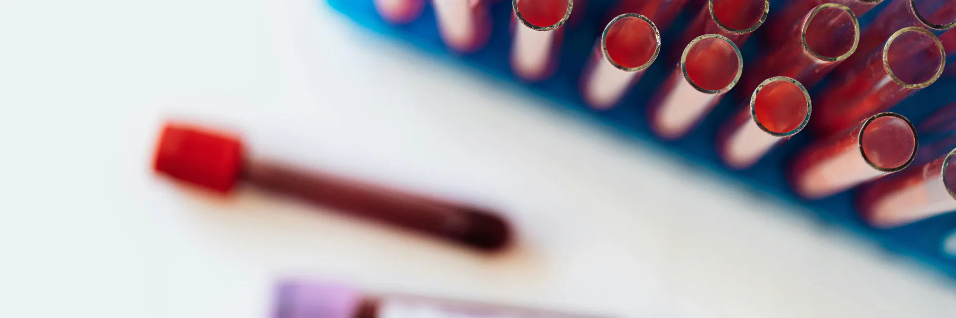 Waldenstrom Macroglobulinemia Immunophenotypes and its Relation with others Hematopathies Banner