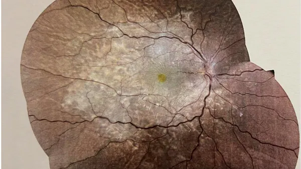 Bilateral Macular Edema Complicating Severe Pre-Eclampsia
