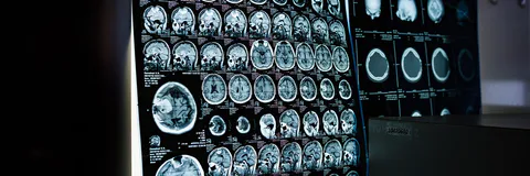 Clinical and Epidemiological Profile of Patients  with Ewings Sarcoma
