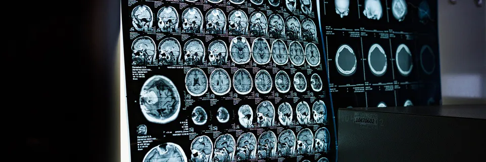 Clinical and Epidemiological Profile of Patients  with Ewings Sarcoma Banner