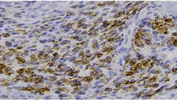 Clinical and Epidemiological Profile of Patients  with Ewings Sarcoma