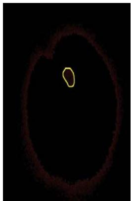 Segmentation of Cancerous Mammography using MATLAB