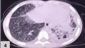 Pulmonary Zygomycosis in a Patient with X-CGD
