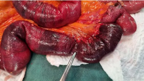 A Case Report of Management of Intestinal Obstruction in a Patient with Situs Inversus Abdominalis