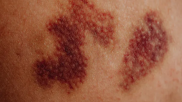 Epidemiological, Clinical, Paraclinical, Therapeutic, Evolutionary, and Prognostic Aspects of Intraparenchymal Hematomas in the Medical Neurocritical Care Unit of the Ibrahima Pierre NDIAYE Neuroscience Clinic: A Study of 72 Cases