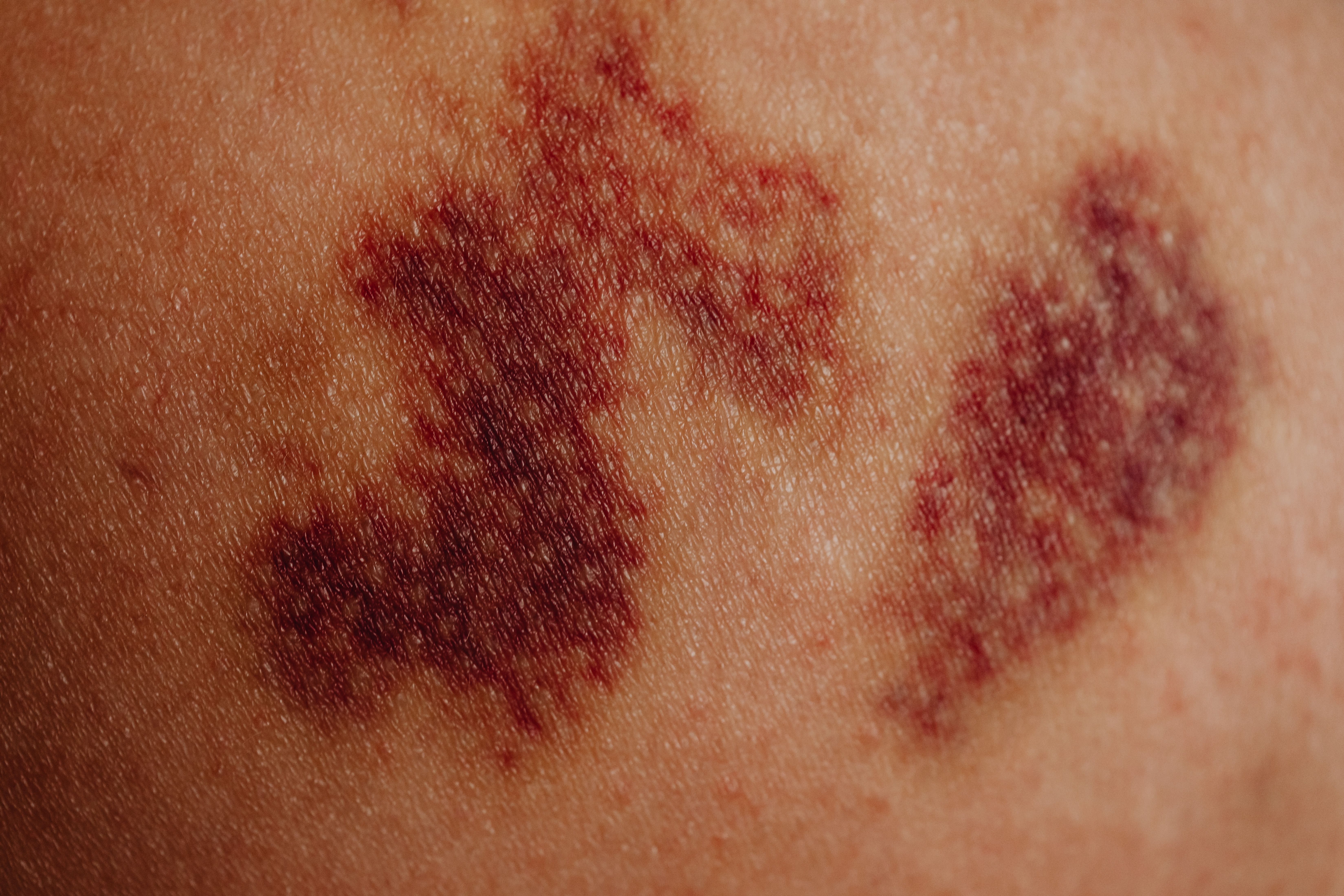 Epidemiological, Clinical, Paraclinical, Therapeutic, Evolutionary, and Prognostic Aspects of Intraparenchymal Hematomas in the Medical Neurocritical Care Unit of the Ibrahima Pierre NDIAYE Neuroscience Clinic: A Study of 72 Cases