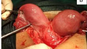 Uniting the Uteri: A Case Series
