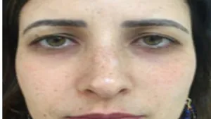 Traumatic Facial Injury Treated by Botulinum Toxin A