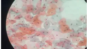 Fractional CO2 Laser in the Treatment of Post-Menopausal Vaginal Atrophy Fractional CO2 Laser in Post-Menopausal Women