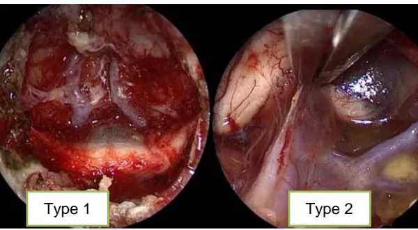 Surgical Cavity in Extended Endoscopic Endonasal Approach to the Skull Base and their Relationship with Cerebrospinal luid Leak