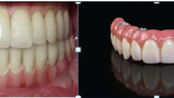 Prosthodontic Treatment Options in Implant Dentistry- A Review Article