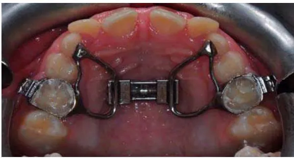 Diagnosis and Orthodontic Treatment of Obstructive Sleep Apnea Syndrome Children—A Systematic Review