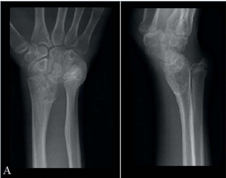 Madelung Deformity: Surgical Correction with Radial Dome Osteotomy
