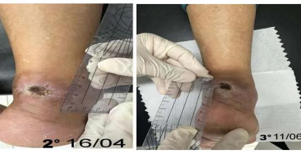 Use of Platelet-Rich Plasma (PRP) in the Treatment of Difficult-Healing Wounds: Case Report