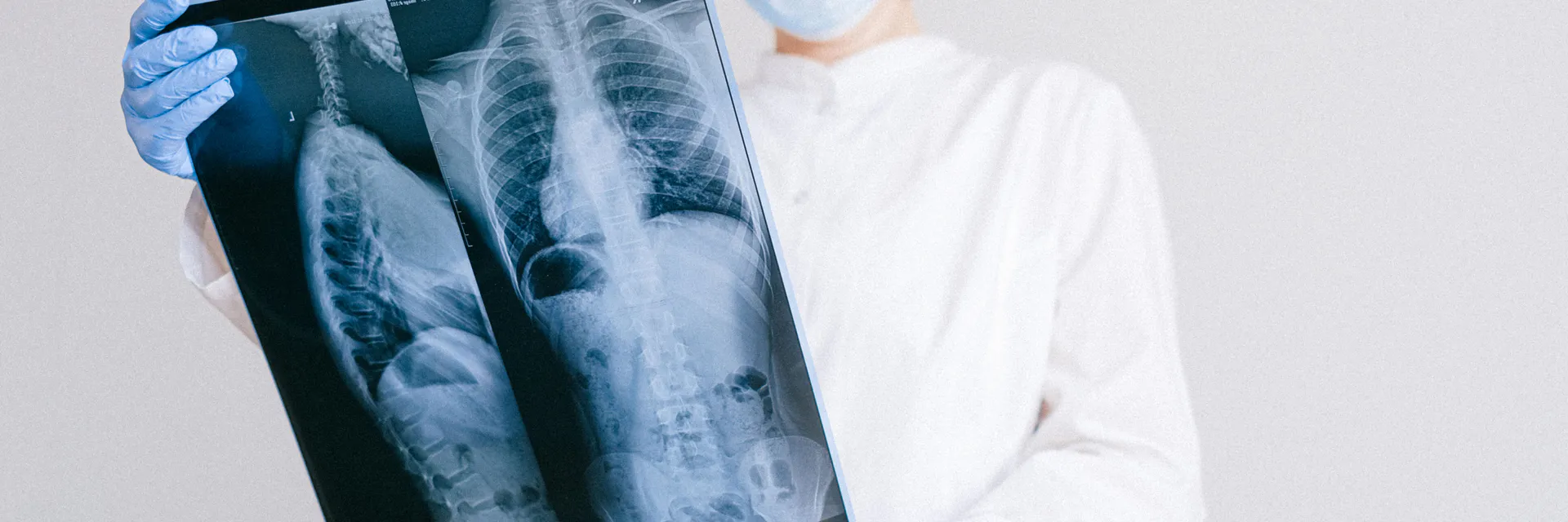 Subdiaphragmatic Abscess: Complication of Emergency Laparotomy Banner