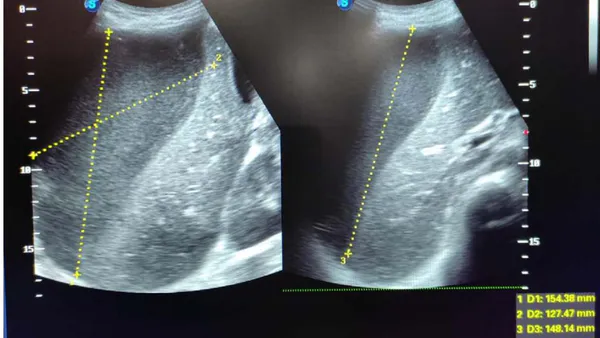 Subdiaphragmatic Abscess: Complication of Emergency Laparotomy