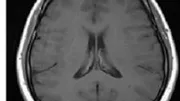 ICA and Sparse ICA for Biomedical Signals & Images Denoising Based on Fractional Weibull Distribution