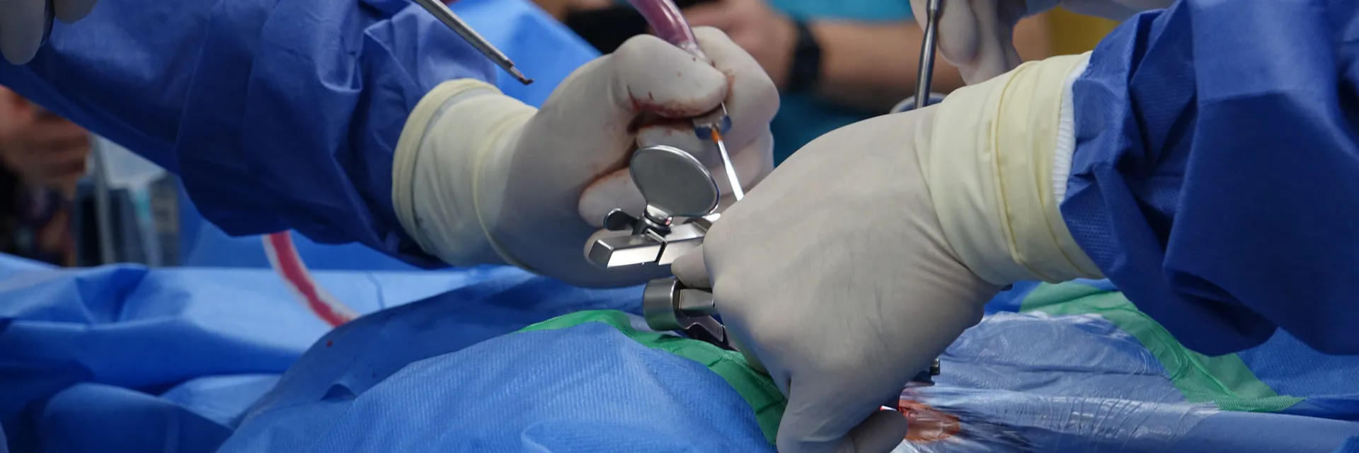 Rare Case of Young Patient with Intraventricular Angiomatous Meningioma Banner