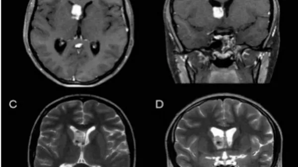 Rare Case of Young Patient with Intraventricular Angiomatous Meningioma