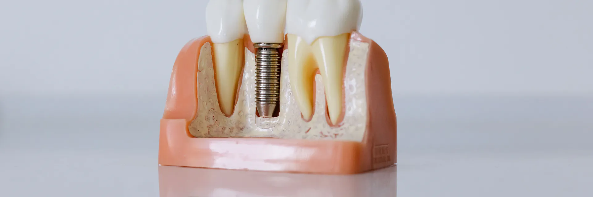 Treat and Restore Compromised Sockets Immediately with the Novel Vestibular Socket Therapy : A Revolution in Immediate Implant Placement Banner