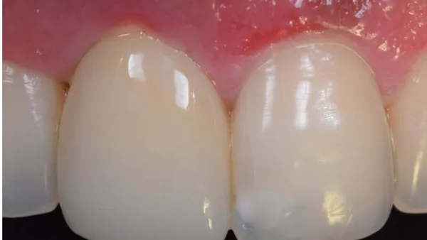 Treat and Restore Compromised Sockets Immediately with the Novel Vestibular Socket Therapy : A Revolution in Immediate Implant Placement