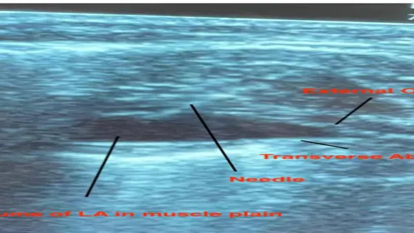 To Compare the Efficacy of TAP Block to Attenuate Pain in Laparoscopic Surgeries when Given in Pre-Incision to Post-Operative Period