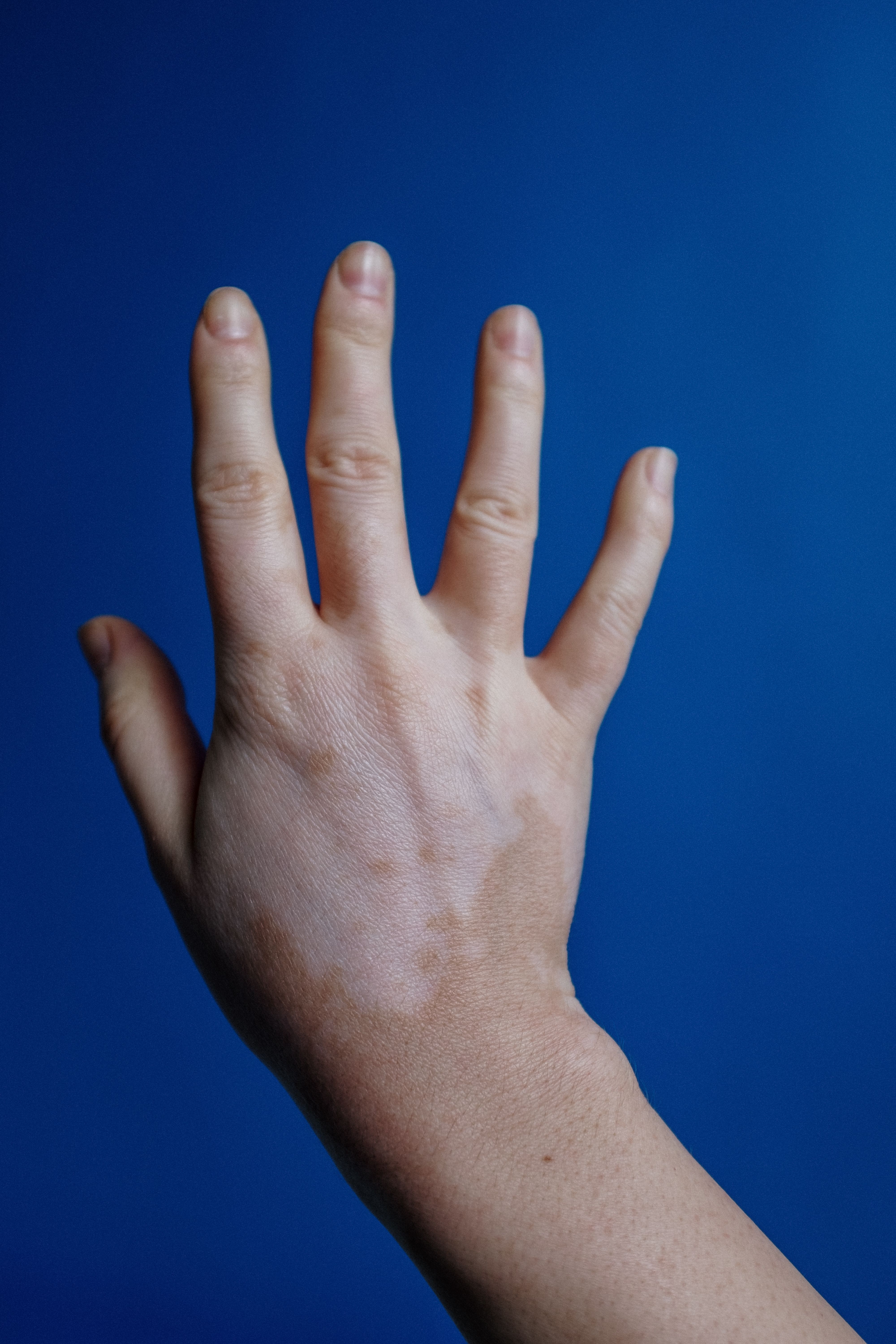 Bulbar Syndrome Revealing Anti-PM/SCL Antibody-Positive Scleromyositis: A Case Report