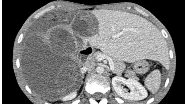 Acute Generalized Peritonitis due to Peritoneal Hydatid Cyst Rupture